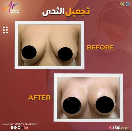 مميزات وعيوب عملية تجميل الثدي